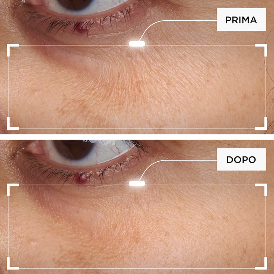 Riduzione di linee, rughe e perdita di elasticità