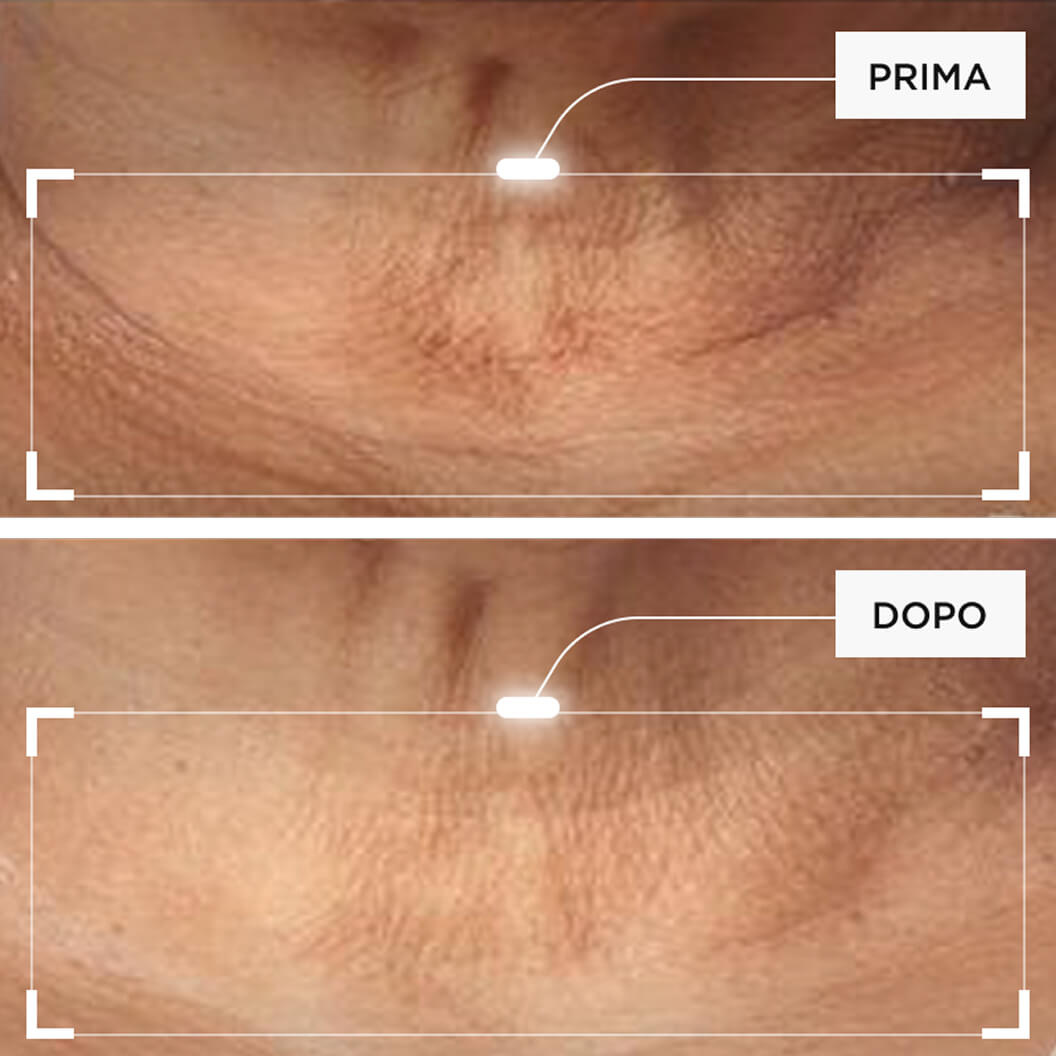 Miglioramento di compattezza, tonicità e definizione di viso, collo e linea mandibolare