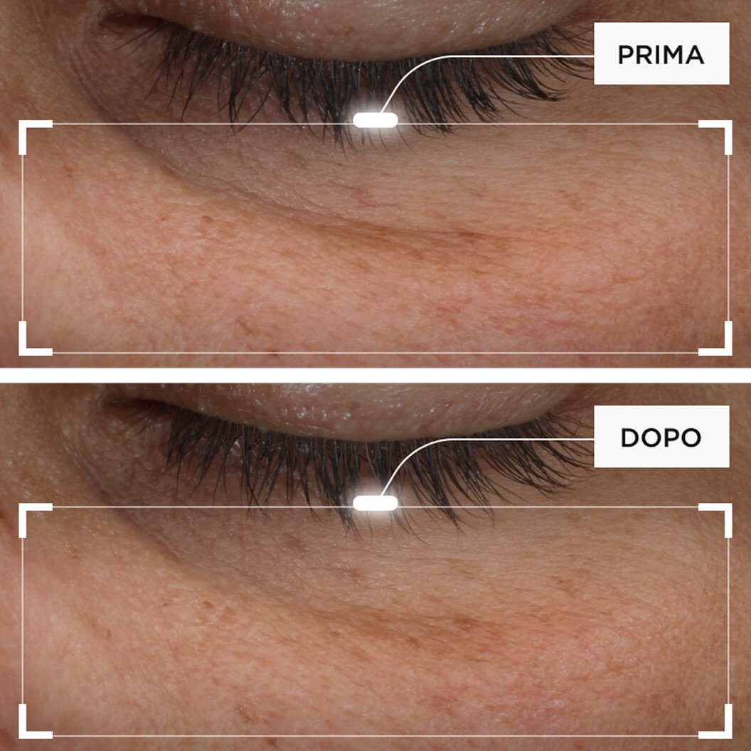 MIlgioramento di occhiaie, borse, zampe di gallina, linee sottili e perdita di tonicità