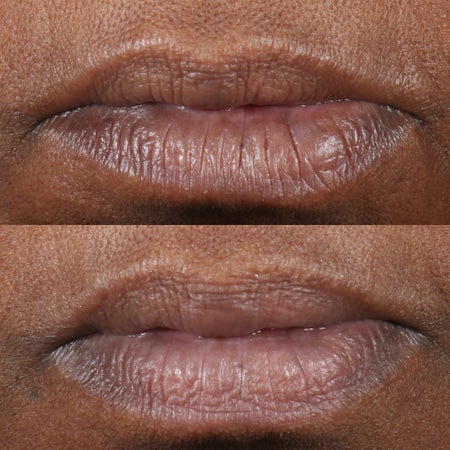 Cold Plasma Plus+ Lip Therapy Immagine 2